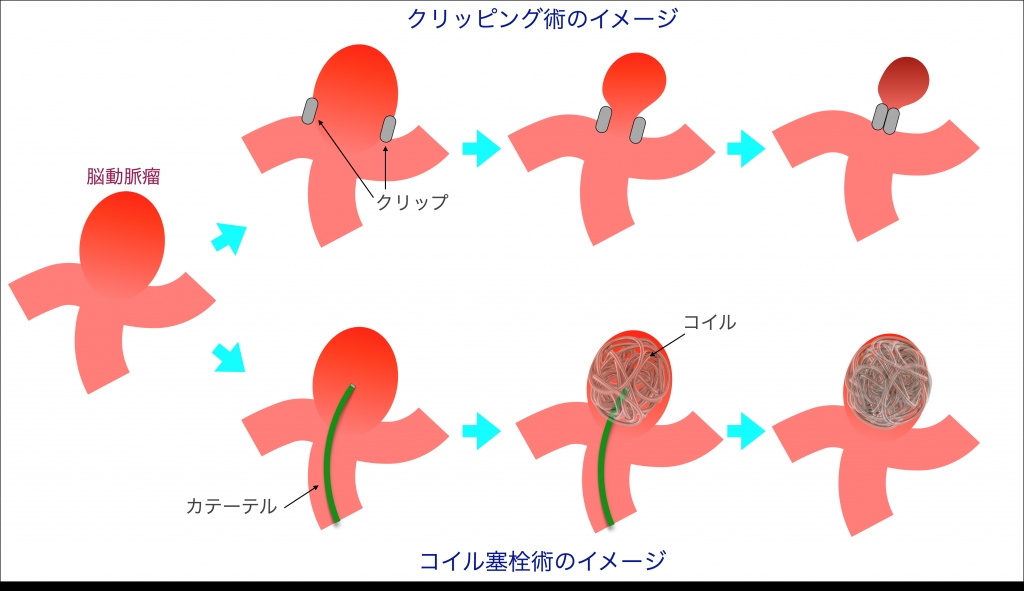 未破裂脳動脈瘤について