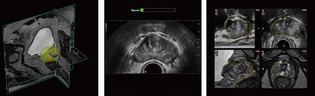 MRI-USフュージョン生検とは? MRI-USフュージョン生検とは?